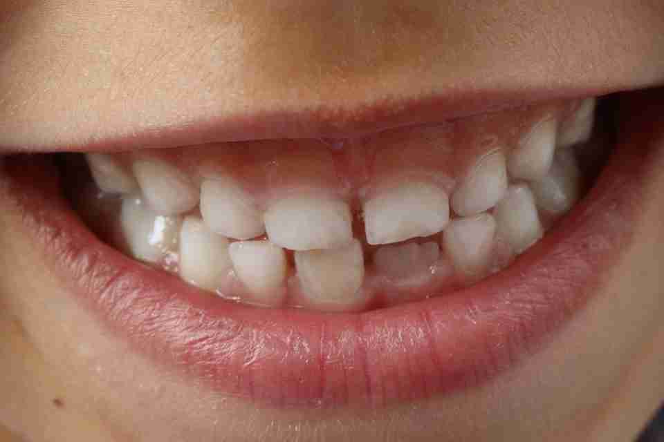 close up of kids mouth while smiling