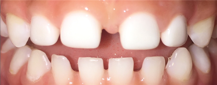 dental image of pediatric teeth